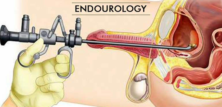 EndoUrological Procedures - Dr. Shyam Mohan